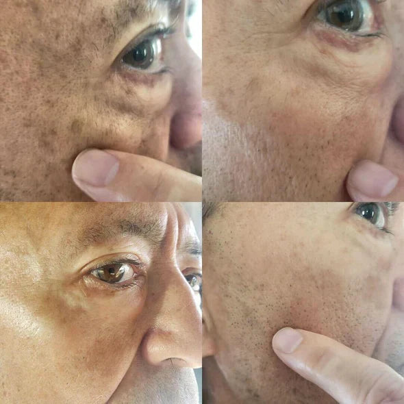 ✨Fast Dark Spot Remover – Melanin Correcting Facial Serum (🔥Last Day Promotion 60% OFF)