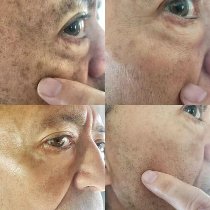 ✨Fast Dark Spot Remover – Melanin Correcting Facial Serum (🔥Last Day Promotion 60% OFF)