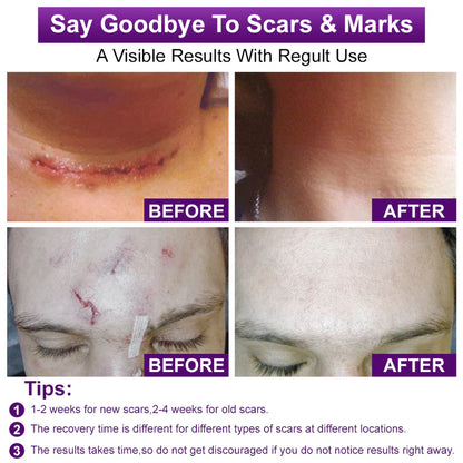 Misspone® Scar Gel – Australian Dermatology Approved for Proven Scar Repair Visible Results, Healthier Skin, Renewed Confidence
