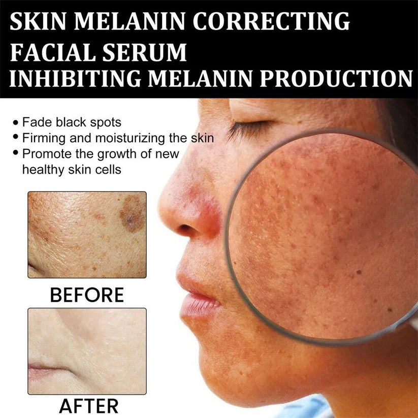 ✨Fast Dark Spot Remover – Melanin Correcting Facial Serum (🔥Last Day Promotion 60% OFF)