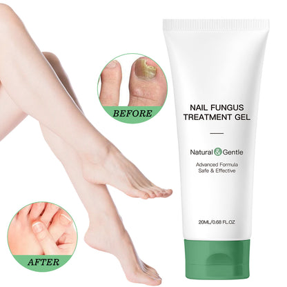 💅 Say Goodbye to Nail Fungus – Fast, Natural Relief for Healthy, Beautiful Nails 🌿