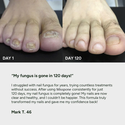 💅 Say Goodbye to Nail Fungus – Fast, Natural Relief for Healthy, Beautiful Nails 🌿